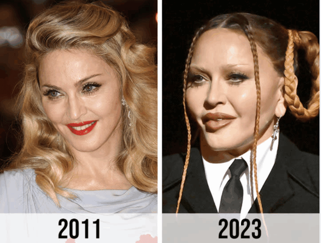 Celebrity who has received too much filler and now suffers from volume imbalance